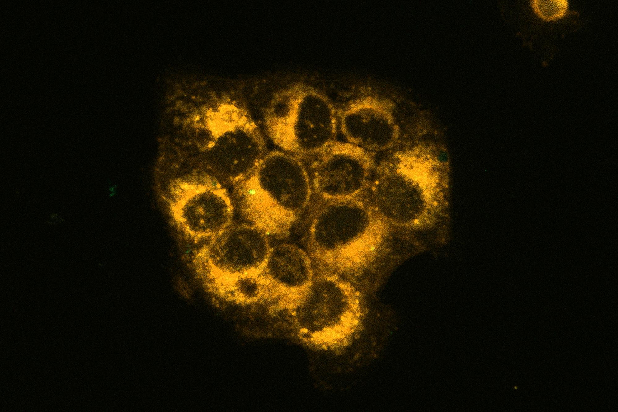 Under an inverted fluorescence microscope, lipid peroxidation stress in cancer cells can be clearly visualized, confirming the status of ferroptosis.