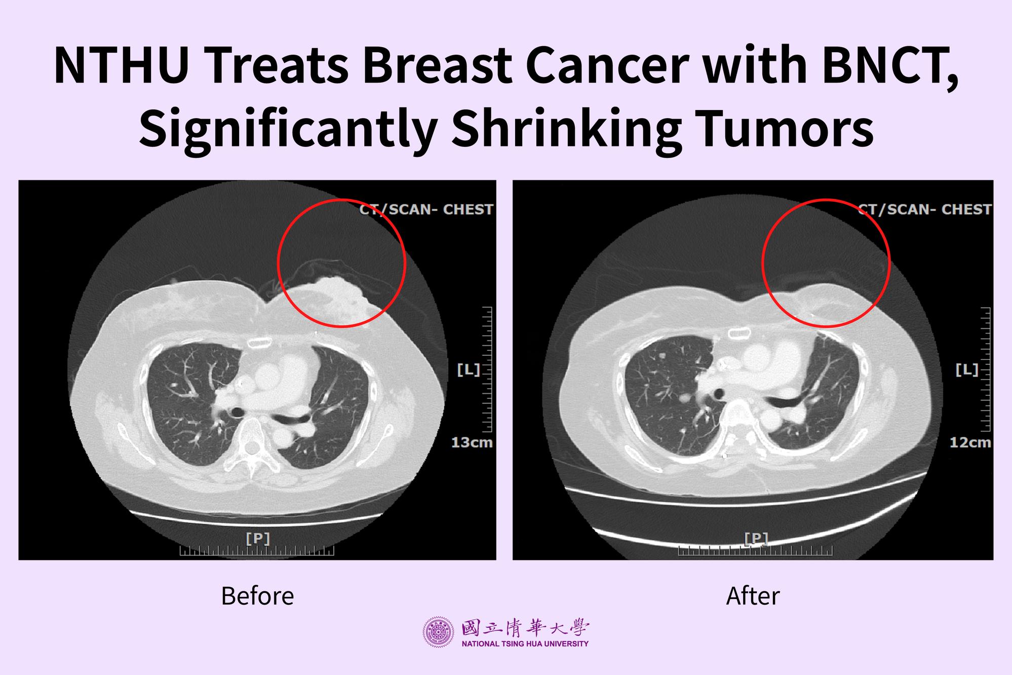 CT images show significant shrinkage of the tumor within the irradiated area after a breast cancer patient received BNCT. The tumor is circled in red. (Photo provided by Dr. Yi-Wei Chen)